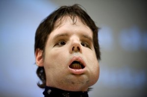 Spain Face Transplant Spain Face Transplant